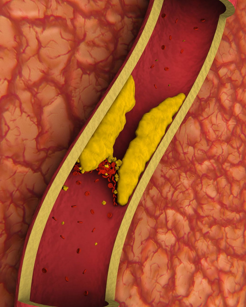 Mozgásterápia érelmeszesedés ellen